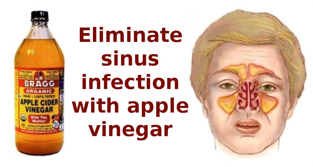 How to eliminate sinus infection within a few minutes using apple cider vinegar!