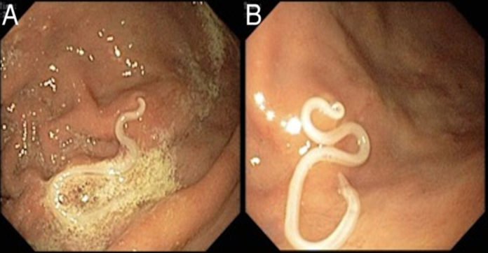 Doctors pulled living worms out of a 32-year-old man after eating this popular dish