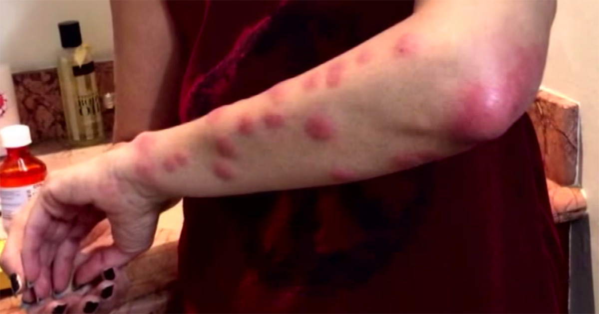 A woman woke up in the morning with red blisters - now she is sharing her important story