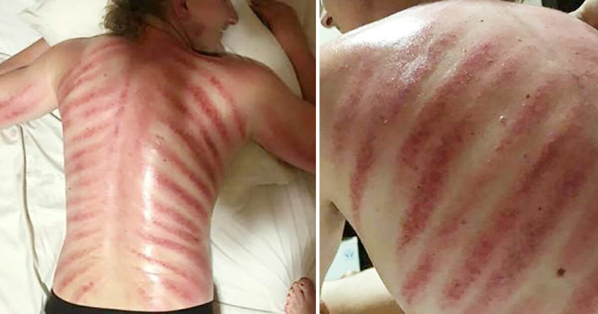 The husband woke up with red stripes all over his back in a tourist spot - his wife immediately realized their big mistake