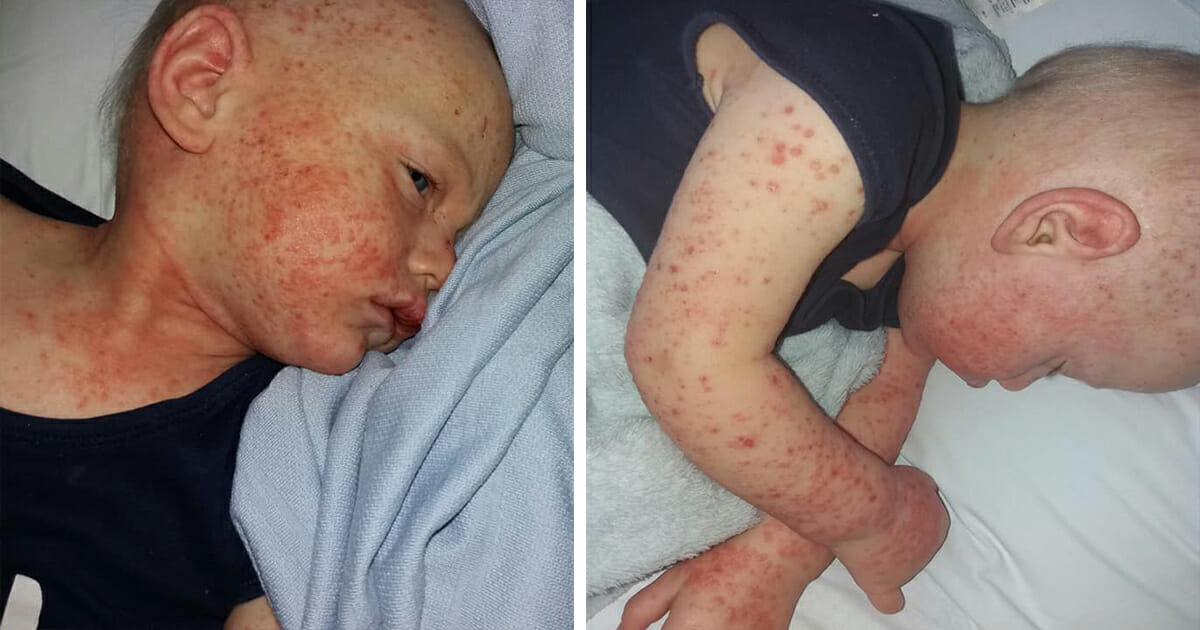 A mother wants everyone to know that one kiss left her son in the hospital with a life-threatening rash