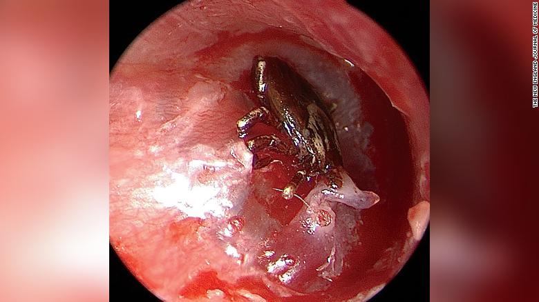 9-year-old boy suffered an annoying buzzing in his ear for days. Doctors were shocked by what they found inside.