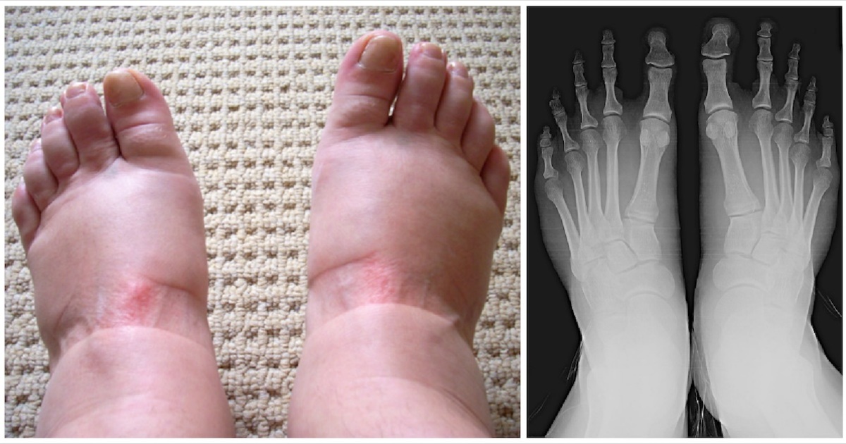 Swollen feet: 9 warning signs you must not ignore