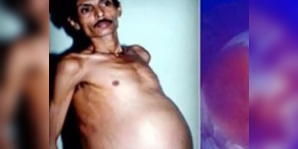 He was mocked as 'pregnant' for years, but the surgery revealed a shocking truth
