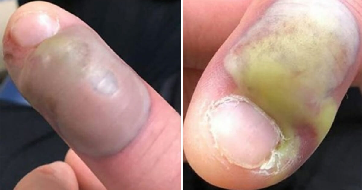 A man got hospitalized and underwent emergency surgery after receiving a fatal infection from biting his nails