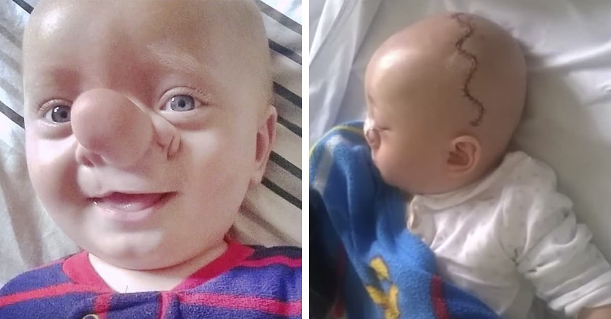 The 'Pinocchio Baby' was assaulted because of his huge nose: 3 years later his transformation was completed thanks to a complex surgery he underwent