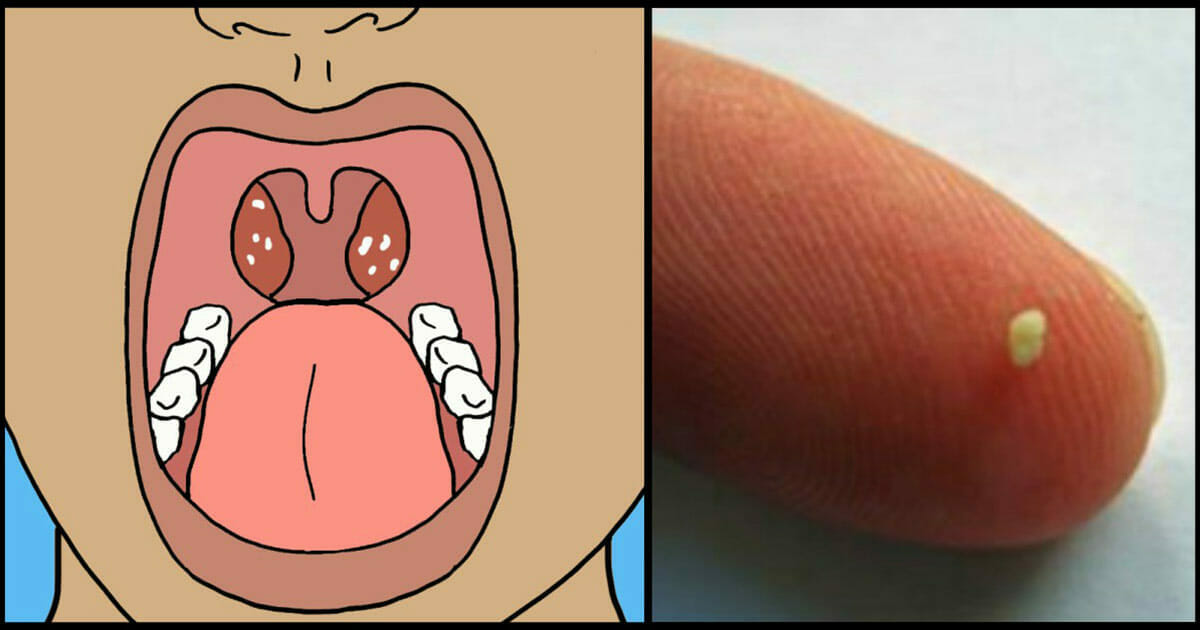 Tonsil stones: 8 warning signs of the body that you should never ignore