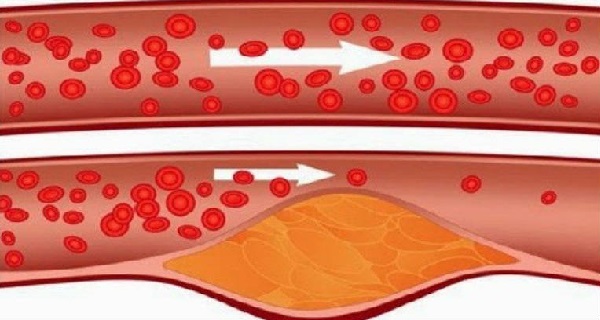 4 tablespoons in the morning: this drink helps lower cholesterol, blood pressure, and opens the arteries