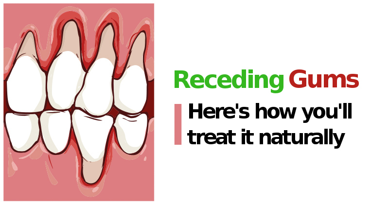 Receding gums: causes and natural ways to cure