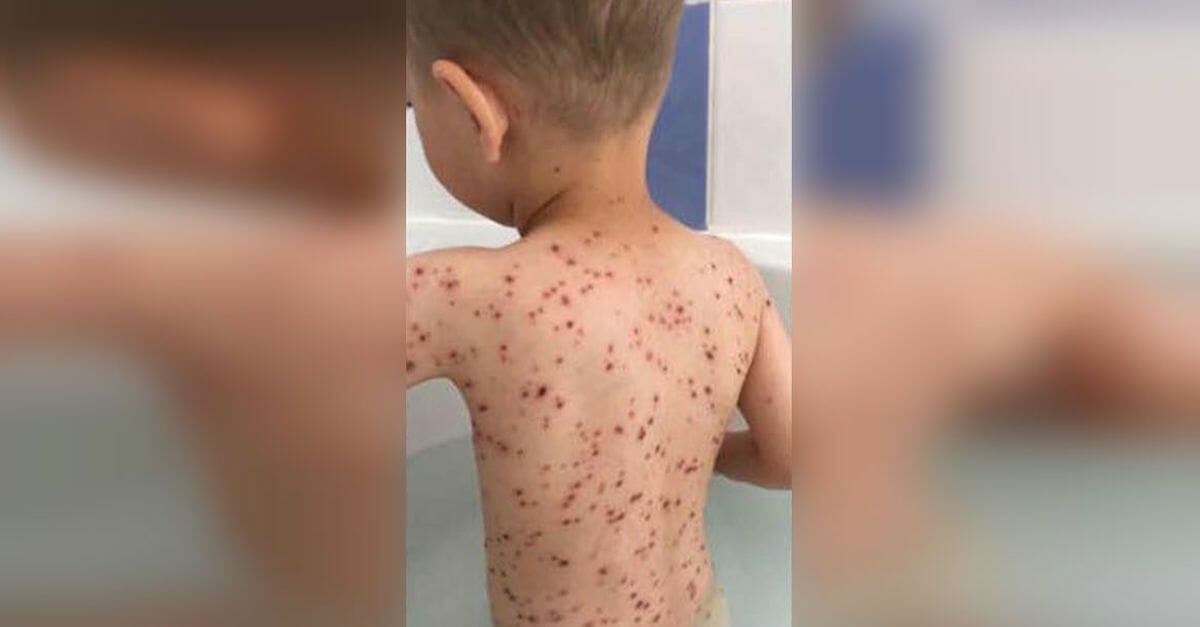 Mother heard her son crying because of high fever, discovered red bumps all over him and immediately realized the doctor's fatal mistake