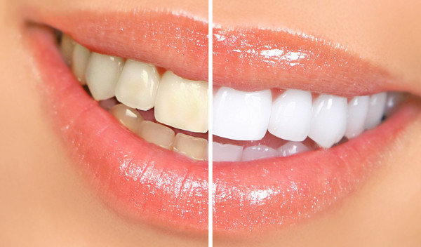 Natural tips and tricks that will ensure you have a million dollar smile