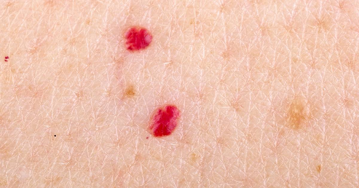 If you have these red dots on your skin, this is what it means