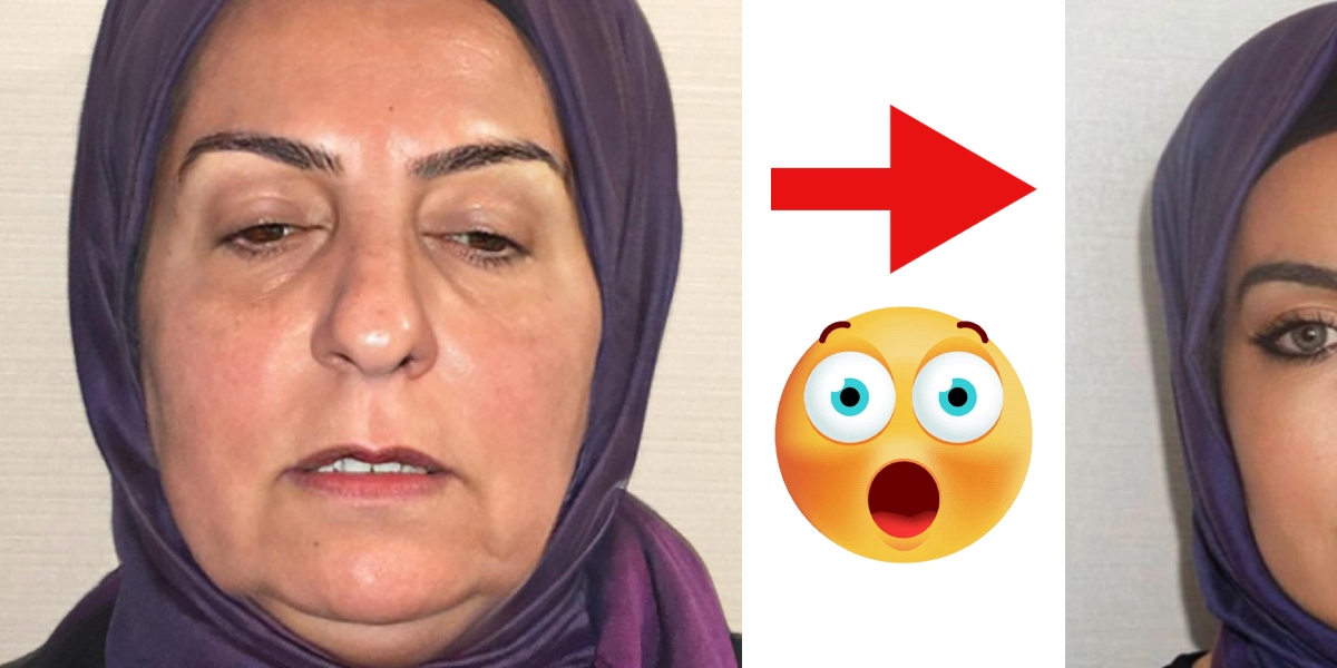 Is this the same woman? Before and after photos posted by a Turkish plastic surgeon left people speechless
