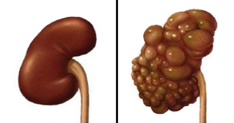 5 common things people do that harm their kidneys