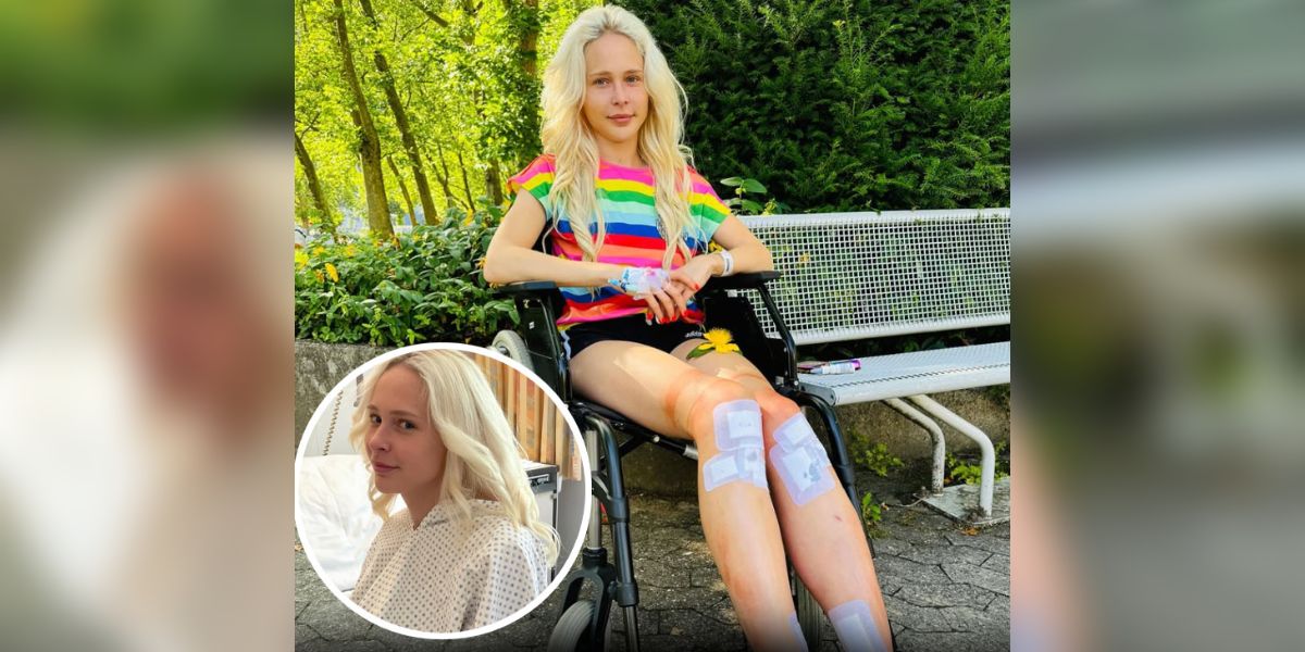 Woman paid over $160,000 to lengthen her legs - and now she deeply regrets the decision