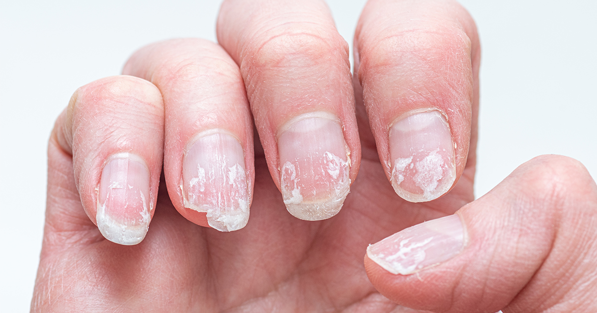 If your nails look like this, you might be suffering from various illnesses: here is what you need to know