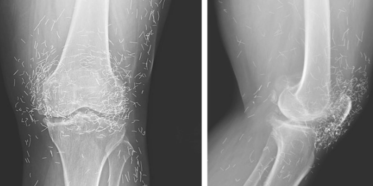 A 65-Year-Old woman went to the doctor for severe knee pain—the x-rays left everyone in shock